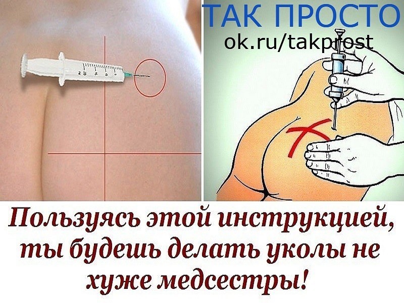Укол в ягодицу схема фото куда Укол в ягодицу схема фото куда